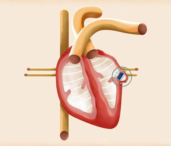 A drawing of the heart showing where the WATCHMAN device is implanted